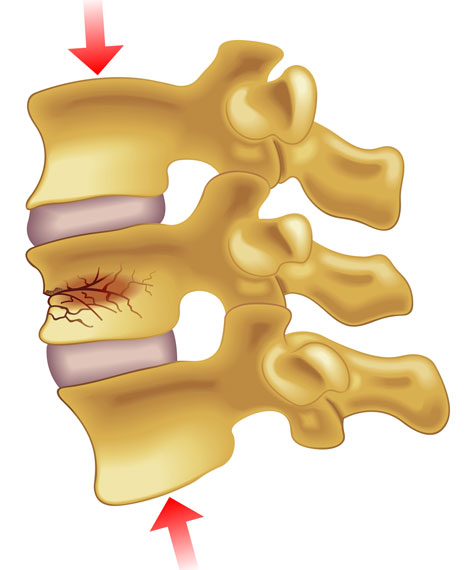 vertebral-compression-fractures-restore-medical-partners