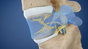 BVN in Vertebra - Intracept Procedure