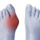 How to Treat Painful Bunions